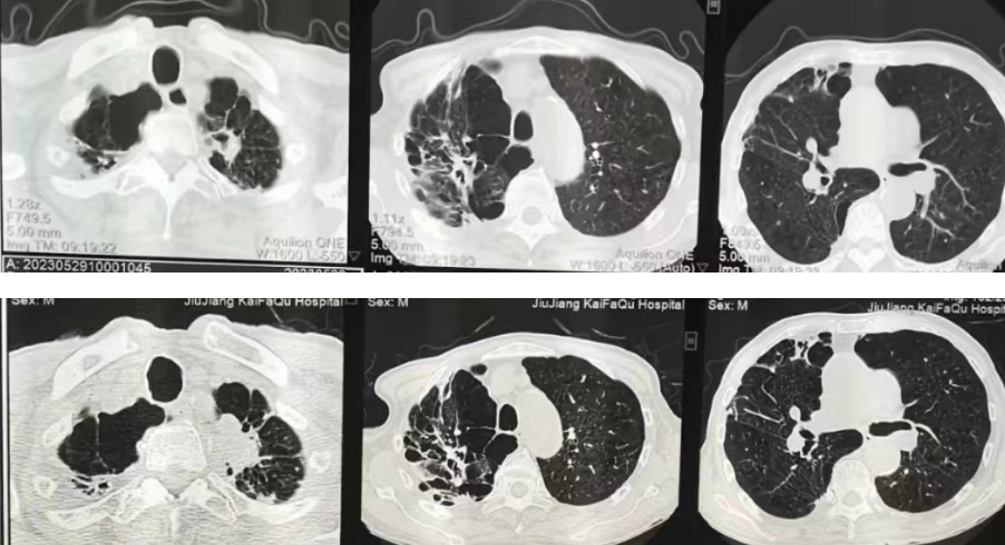 肺瘢痕癌丨细微影像征象发现大问题- 掌中九江