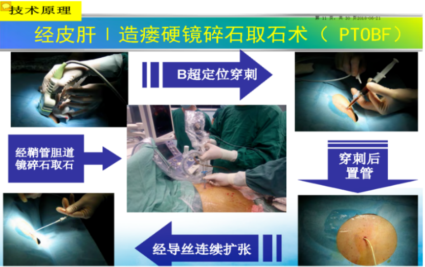 市一医院总院肝胆外科成功完成首例PTOBF微创手术治疗复杂性胆管结石 